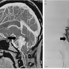 Neuroradiology Techniques for Assessing Cerebral Aneurysms