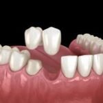 Questions To Ask a Dentist Before Getting a Dental Bridge