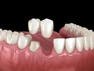 Questions To Ask a Dentist Before Getting a Dental Bridge