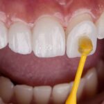 Exploring the Durability of Different Veneer Materials