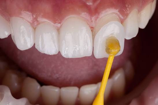 Exploring the Durability of Different Veneer Materials