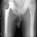 Factors To Review Before Joint Replacement Surgery