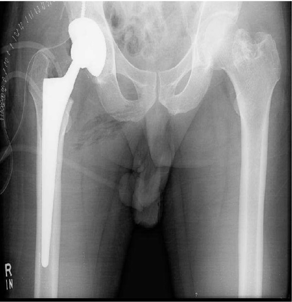 Factors To Review Before Joint Replacement Surgery