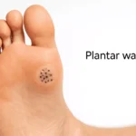 Getting Professional Help for a Plantar Wart