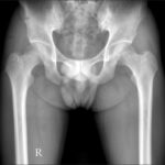 The Relationship Between Hip Pain and Age-Related Changes