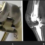 Understanding the Different Types of Knee Surgery