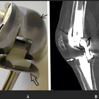 Understanding the Different Types of Knee Surgery