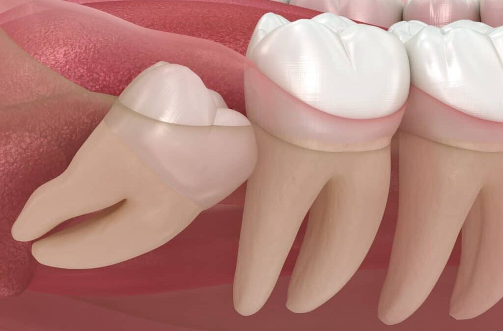 Understanding the Oral Surgery Process for Wisdom Tooth Extraction