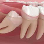 Understanding the Oral Surgery Process for Wisdom Tooth Extraction