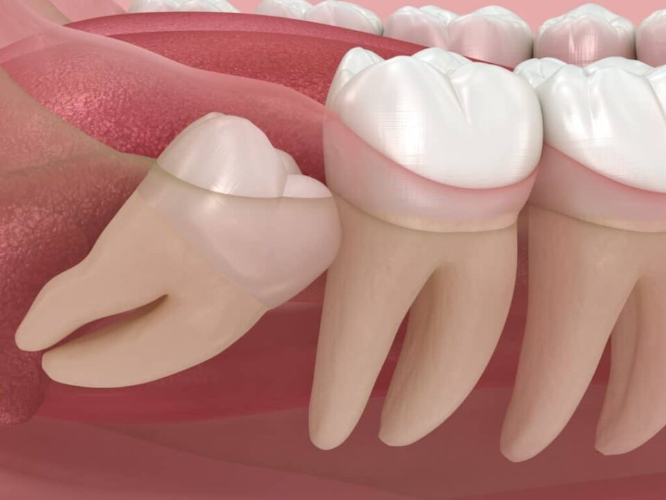 Understanding the Oral Surgery Process for Wisdom Tooth Extraction