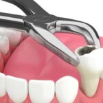 Understanding the Risks Associated With Tooth Extractions