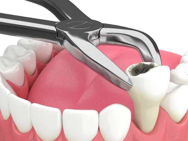 Understanding the Risks Associated With Tooth Extractions