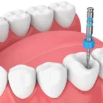 What Steps Should I Take After Root Canal Treatment?