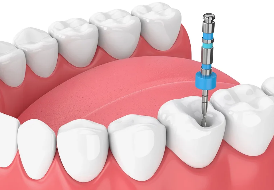 What Steps Should I Take After Root Canal Treatment?