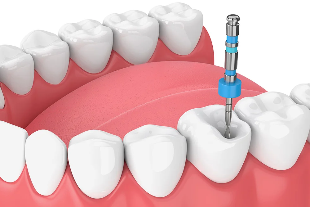 What Steps Should I Take After Root Canal Treatment?